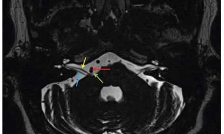 A Multidisciplinary Approach in the Management of Hemifacial Spasm