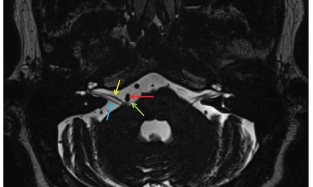 A Multidisciplinary Approach in the Management of Hemifacial Spasm