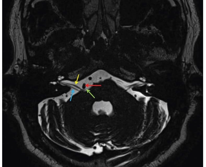 A Multidisciplinary Approach in the Management of Hemifacial Spasm