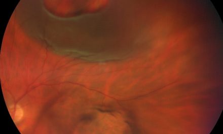 Photo Essay and A Brief Report on New Rhegmatogenous Retinal Detachment Management