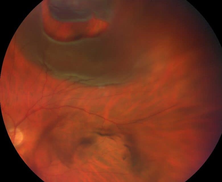 Photo Essay and A Brief Report on New Rhegmatogenous Retinal Detachment Management