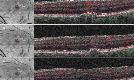 Subjective Dyschromatopsia as presenting symptom of Neovascular Age-Related Macular Degeneration