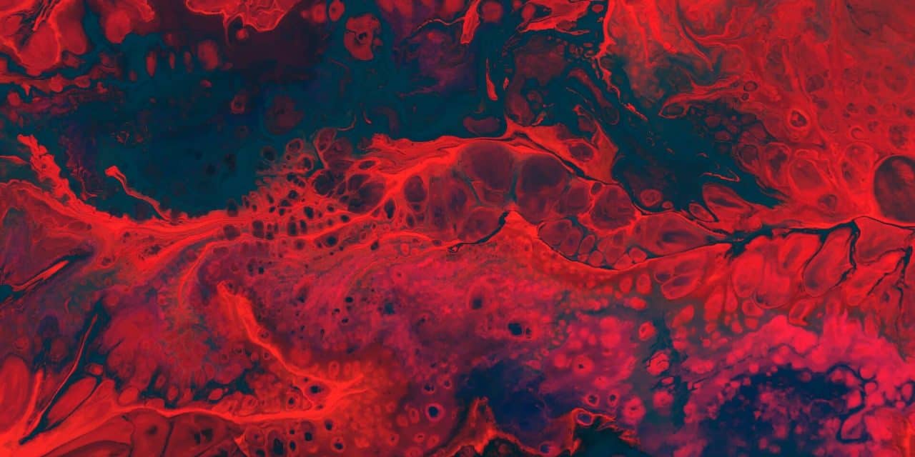 Neovascular Glaucoma: A Case Report and Literature Review