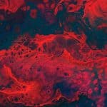 Neovascular Glaucoma: A Case Report and Literature Review