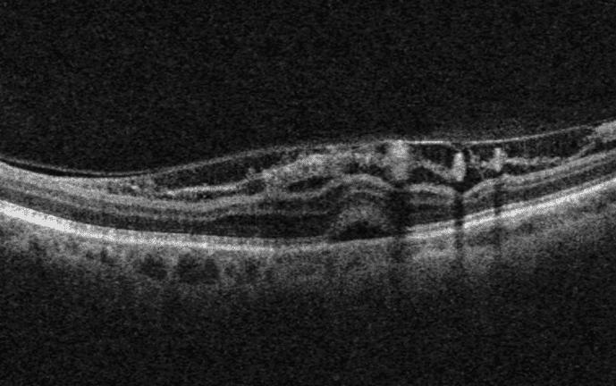 Peripapillary Retinoschisis in a Patient with Severe Primary Open Angle Glaucoma