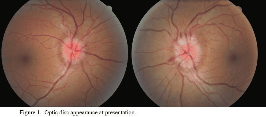 fig 1 pesky papilledema