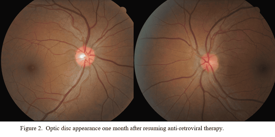 fig 2 pesky papilledema