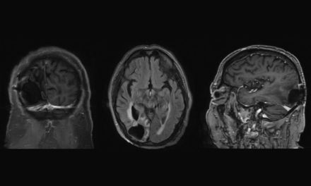 Primary central nervous system diffuse large B-cell lymphoma presenting as homonymous hemianopia
