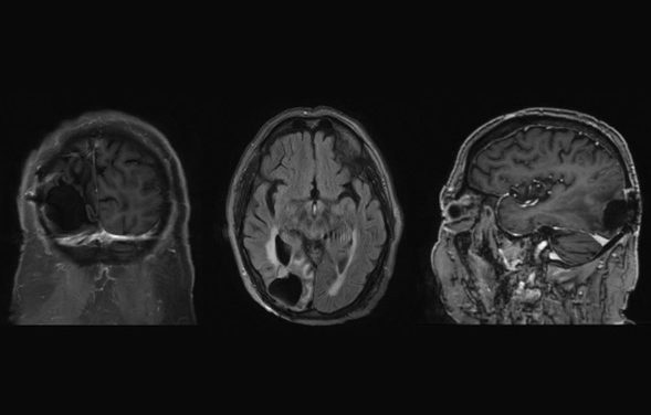 Primary central nervous system diffuse large B-cell lymphoma presenting as homonymous hemianopia
