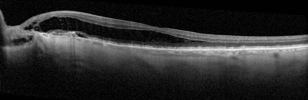 figure 1 optic disc pit