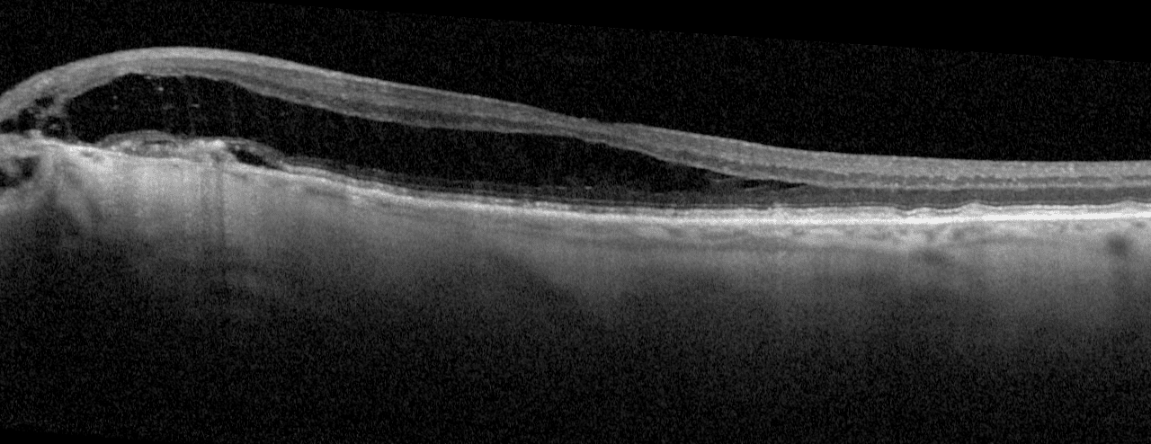Lessons on Juxtapapillary Fluid