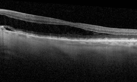 Lessons on Juxtapapillary Fluid