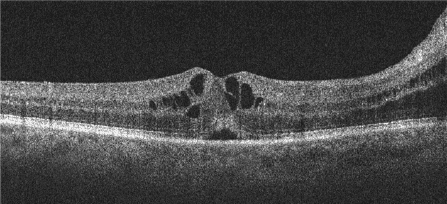 figure 4 spill over from disc edema