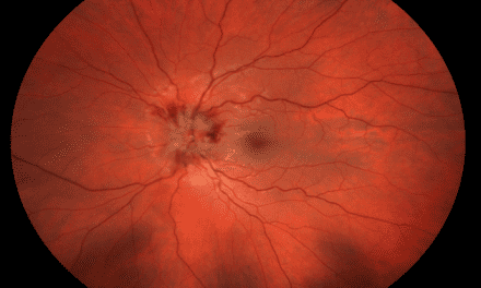 Atypical optic neuritis resulting in a diagnosis of MOGAD