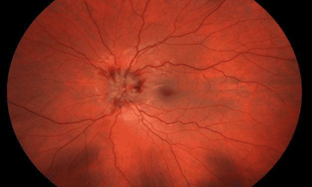 Atypical optic neuritis resulting in a diagnosis of MOGAD