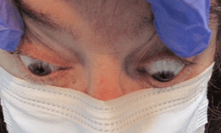 An optometrically driven approach: diagnosing a patient with active thyroid eye disease in the setting of Hashimoto’s thyroiditis