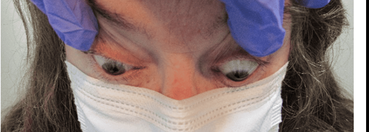 An optometrically driven approach: diagnosing a patient with active thyroid eye disease in the setting of Hashimoto’s thyroiditis