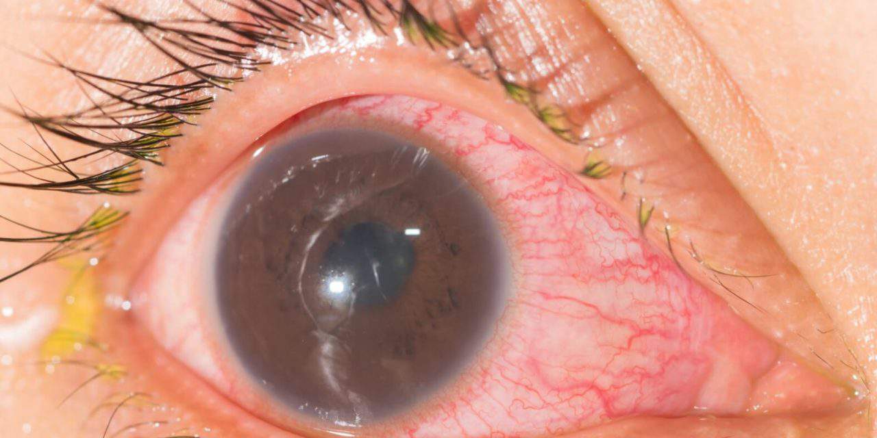 Uveitis: Laboratory Investigations and Current Recommendations on Diagnosis