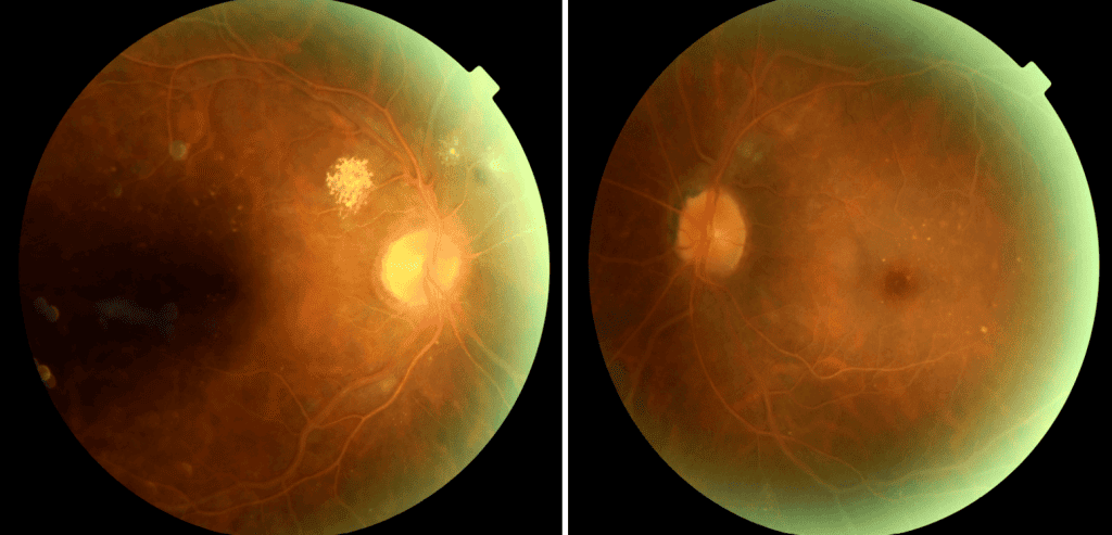 retinopathylabtesting1b (1)