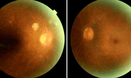 Retinopathy Prompting Laboratory Testing: a report of two cases
