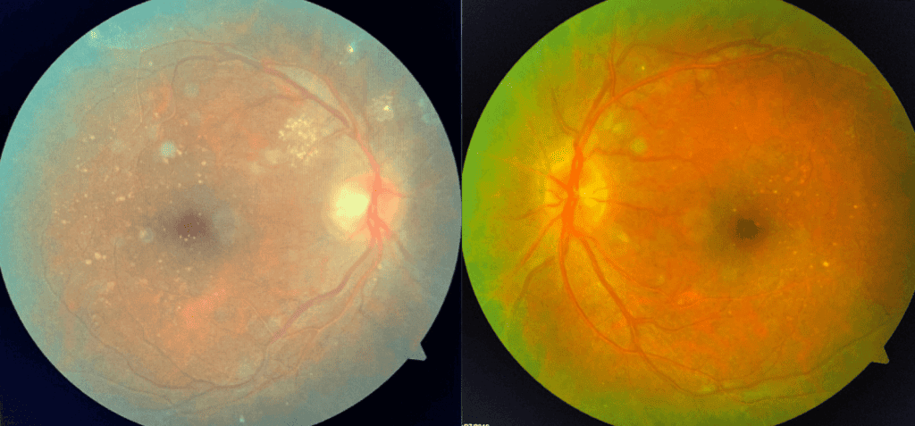 retinopathylabtesting2b (1)