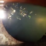 PHOTO ESSAY: Unilateral Christmas Tree Cataract