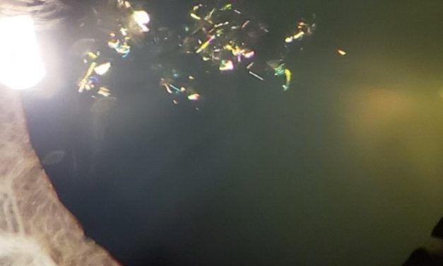 PHOTO ESSAY: Unilateral Christmas Tree Cataract