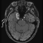 Complications of a Giant Cavernous Carotid Artery Aneurysm