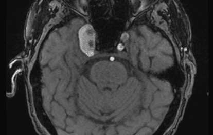 Complications of a Giant Cavernous Carotid Artery Aneurysm
