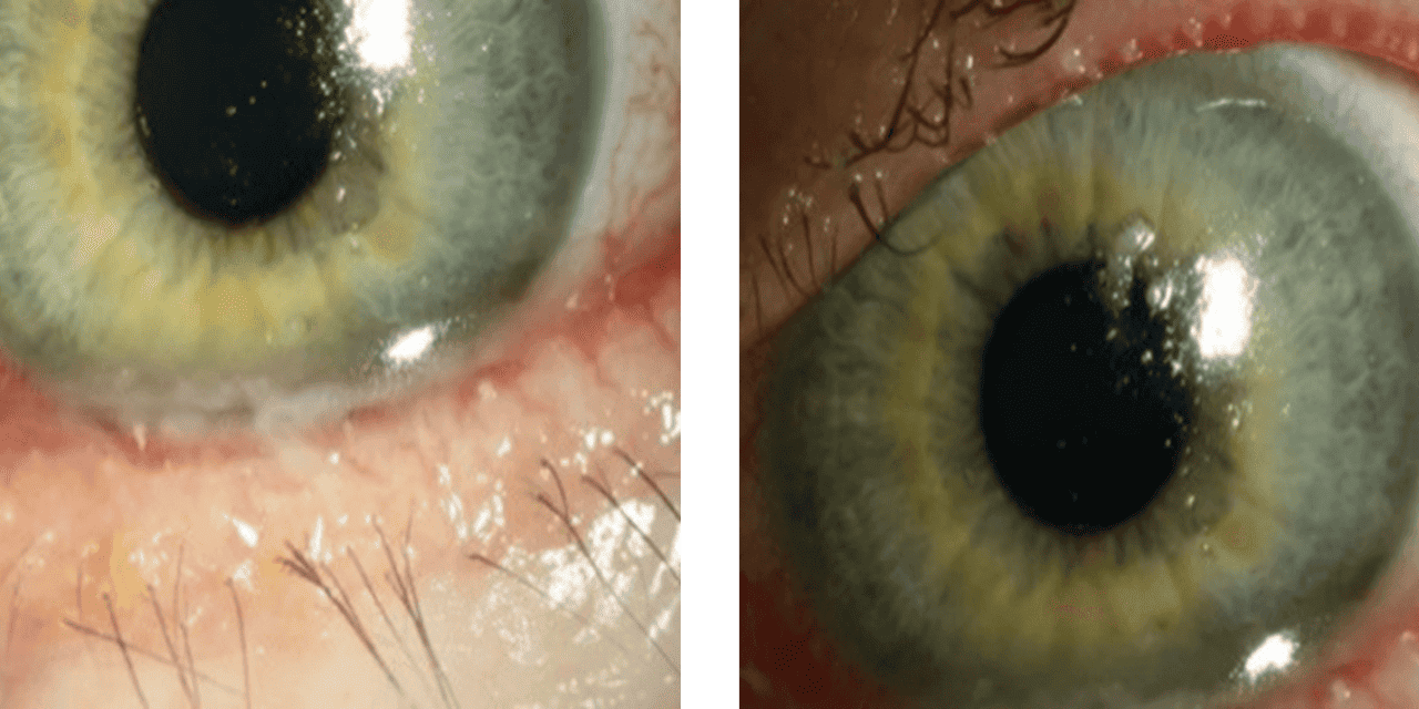 Persistent Corneal Defect in Chronic Progressive External Ophthalmoplegia
