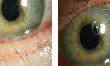 Persistent Corneal Defect in Chronic Progressive External Ophthalmoplegia