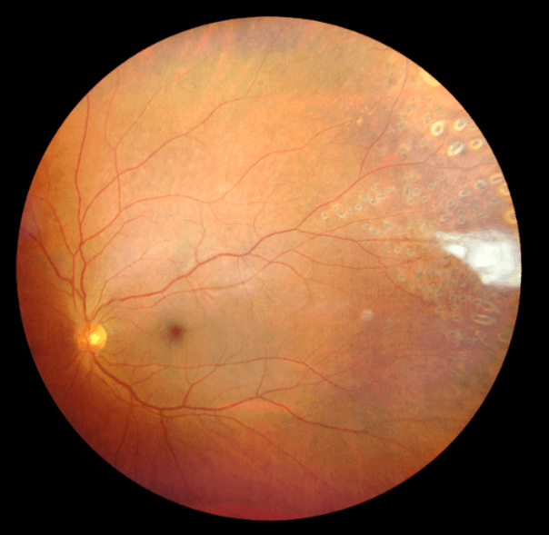 figure 6 sickle cell (1)