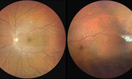 Sickle cell retinopathy: diagnosis, management, and treatment