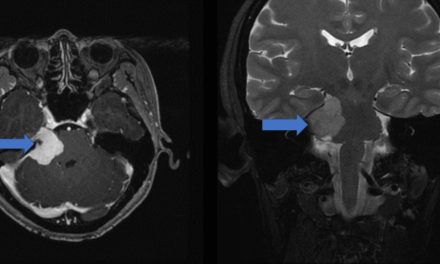 A Surprise Diagnosis from a Unilateral Hearing Loss and Vertigo Case from Cerebellopontine Angle Tumor