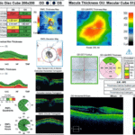Charles Bonnet Syndrome Precipitated by Brimonidine Tartrate