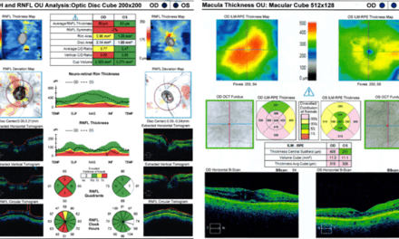 Charles Bonnet Syndrome Precipitated by Brimonidine Tartrate