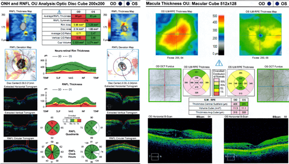Charles Bonnet Syndrome Precipitated by Brimonidine Tartrate