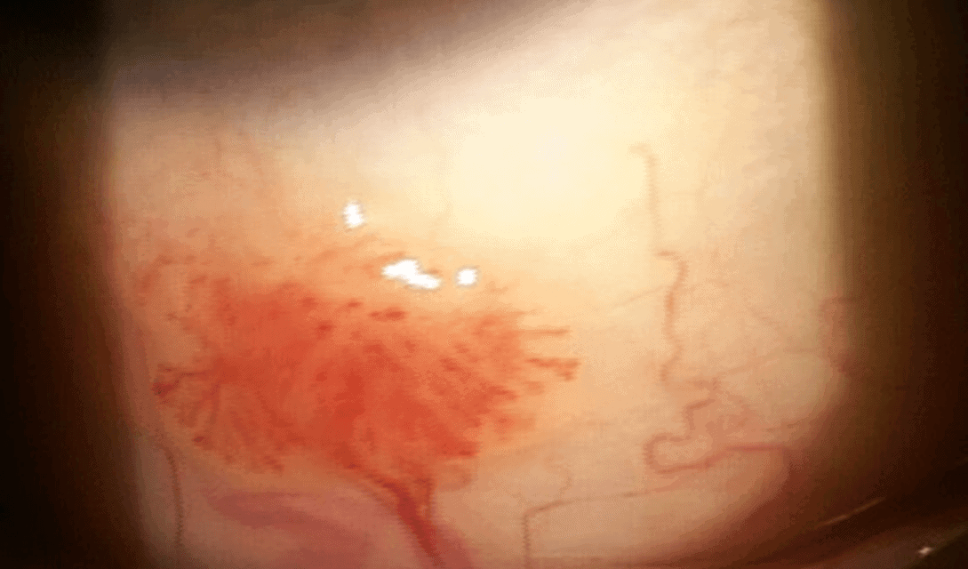 Recurrent Conjunctival Squamous Papilloma