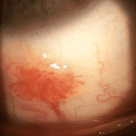 Recurrent Conjunctival Squamous Papilloma