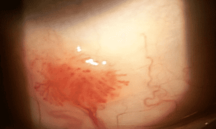 Recurrent Conjunctival Squamous Papilloma
