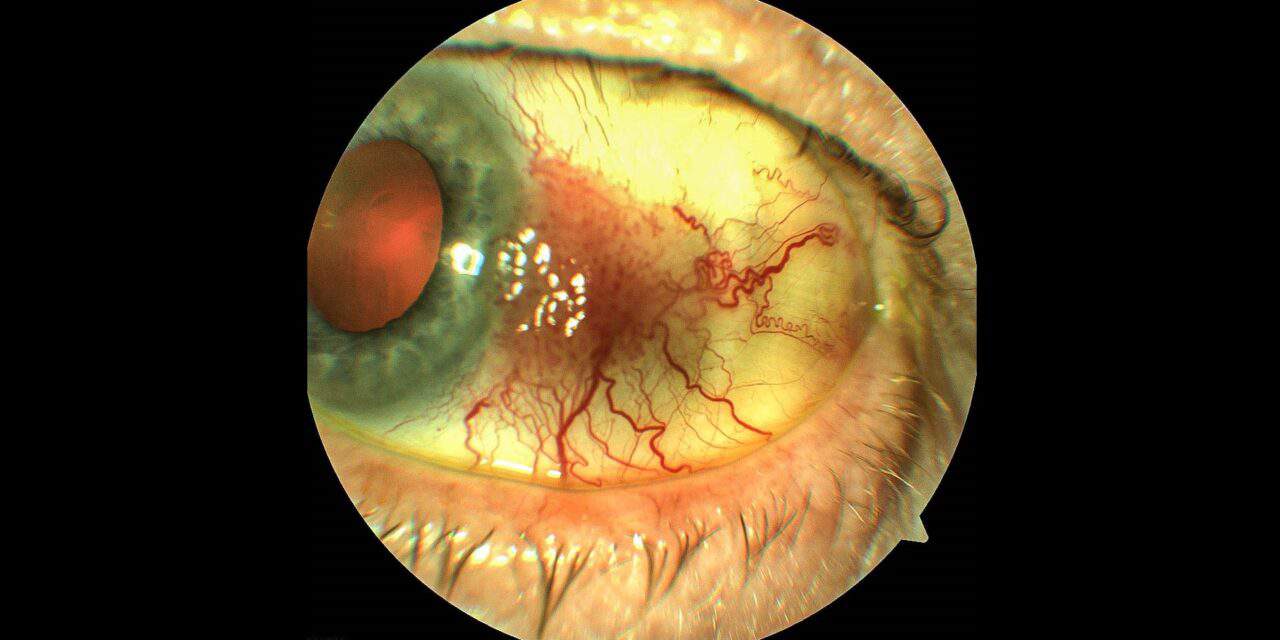 PHOTO ESSAY: “New” Red Eye – A Case of Conjunctival Intraepithelial Neoplasia
