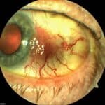 PHOTO ESSAY: “New” Red Eye – A Case of Conjunctival Intraepithelial Neoplasia