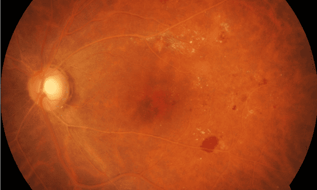Highlighting hypertriglyceridemia with a case of lipemia retinalis