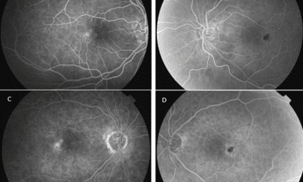 Diagnosing Macular Telangiectasia Type 2
