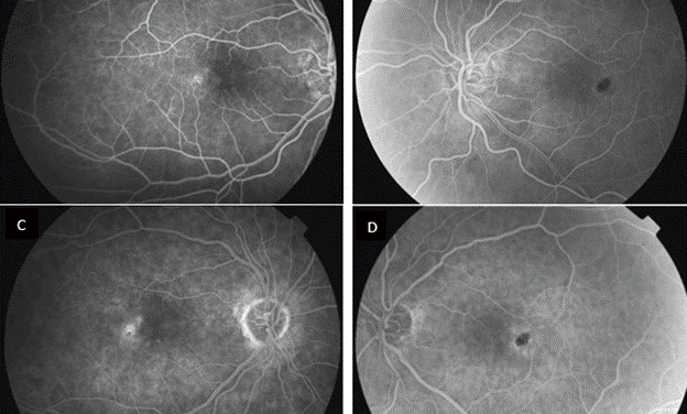 Diagnosing Macular Telangiectasia Type 2