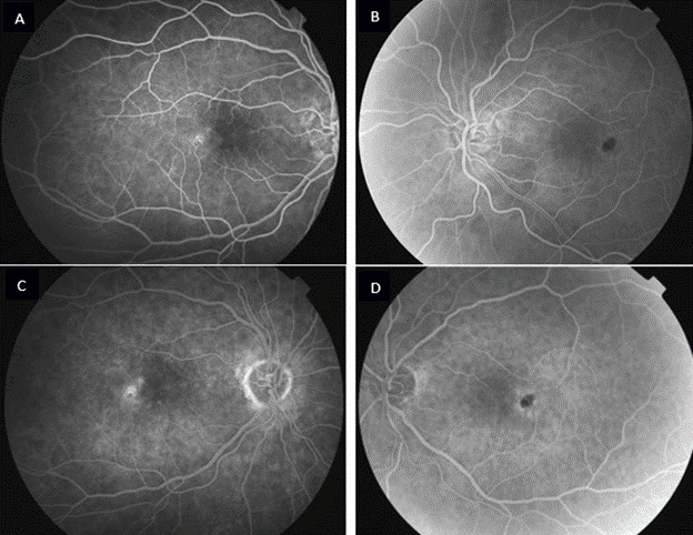 macular telangiectasia fig 3