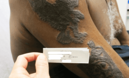 Sarcoid-Induced Uveitis: A Tattooed Journey