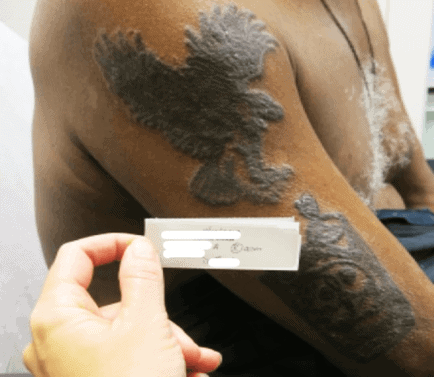 Sarcoid-Induced Uveitis: A Tattooed Journey