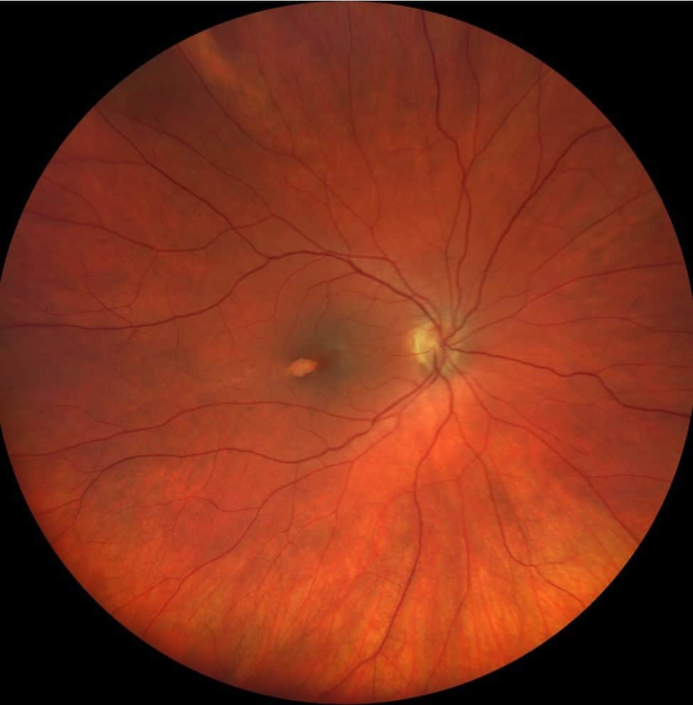 torpedo fundus photo (1)