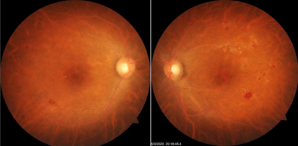 Figure 1. Fundus photography of both eyes. The retina appears much lighter in color and both arteries and veins appear creamy. Intraretinal hemorrhages, cotton wool spots, and exudation are present temporally to the macula in both eyes. The left eye has notably worse retinopathy with CSME. 